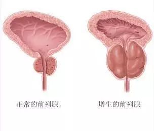 利用先进技术和电切镜的结合必将为前列腺增生患者带来更快捷,更彻底